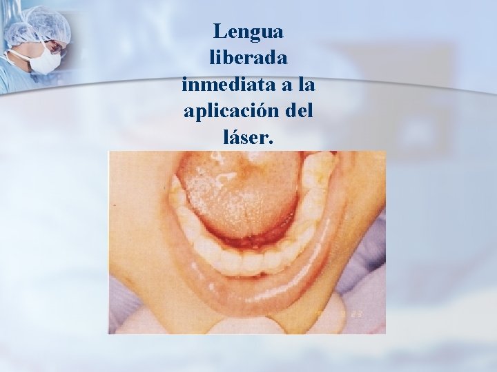 Lengua liberada inmediata a la aplicación del láser. 