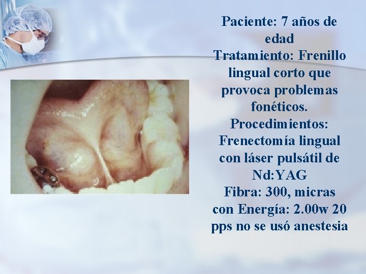 Paciente: 7 años de edad Tratamiento: Frenillo lingual corto que provoca problemas fonéticos. Procedimientos:
