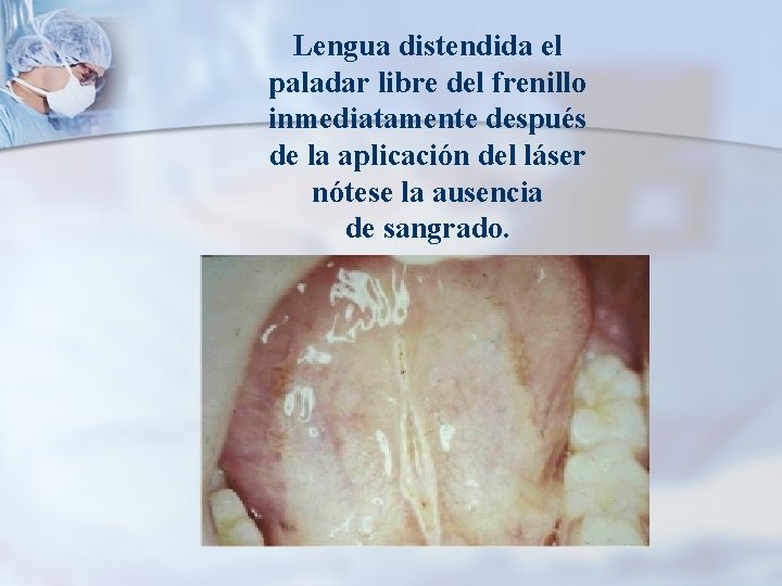 Lengua distendida el paladar libre del frenillo inmediatamente después de la aplicación del láser