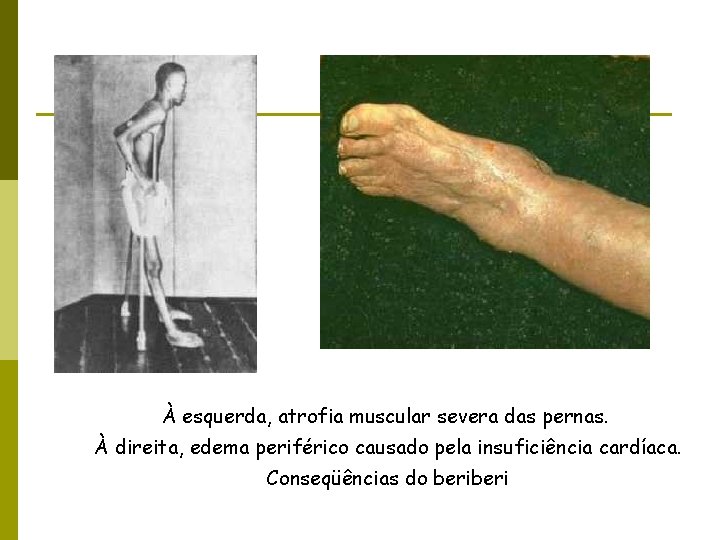À esquerda, atrofia muscular severa das pernas. À direita, edema periférico causado pela insuficiência
