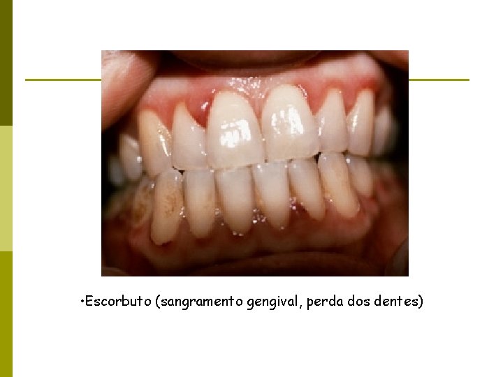  • Escorbuto (sangramento gengival, perda dos dentes) 