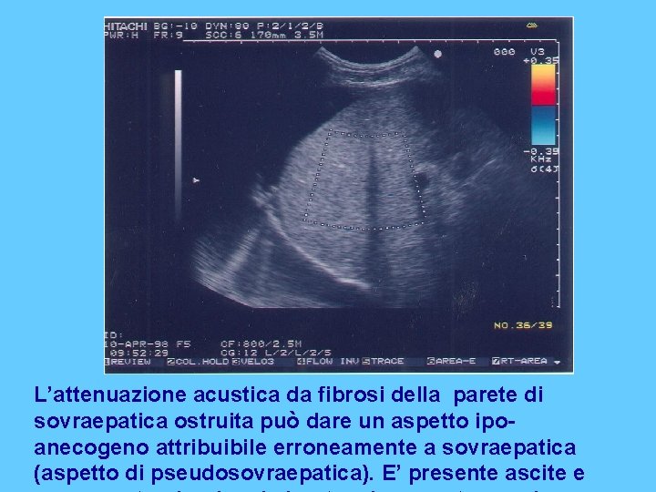 L’attenuazione acustica da fibrosi della parete di sovraepatica ostruita può dare un aspetto ipoanecogeno