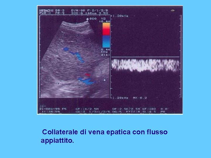 Collaterale di vena epatica con flusso appiattito. 