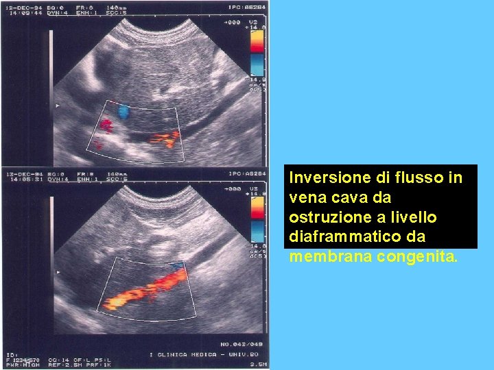 Inversione di flusso in vena cava da ostruzione a livello diaframmatico da membrana congenita.