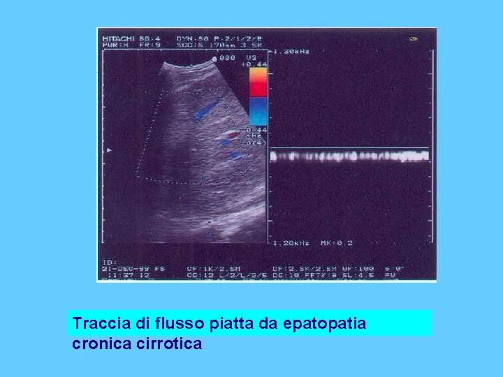 Traccia di flusso piatta da epatopatia cronica cirrotica 