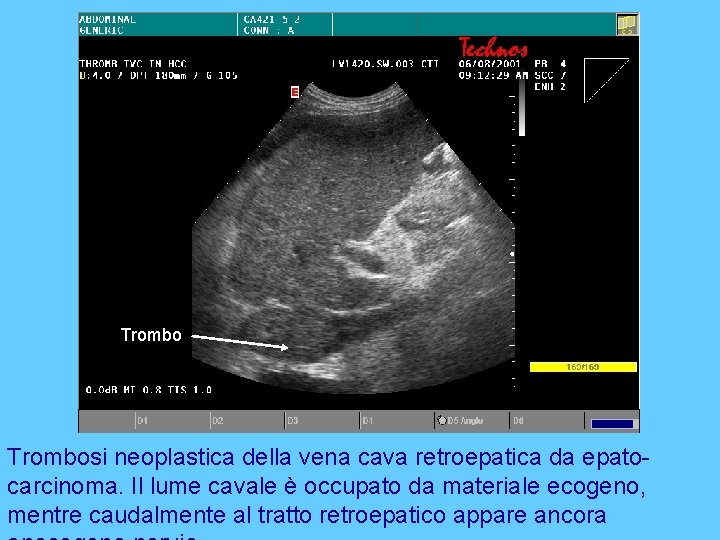 Trombosi neoplastica della vena cava retroepatica da epatocarcinoma. Il lume cavale è occupato da