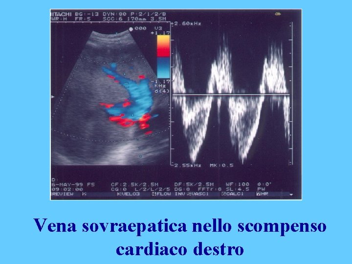 Vena sovraepatica nello scompenso cardiaco destro 