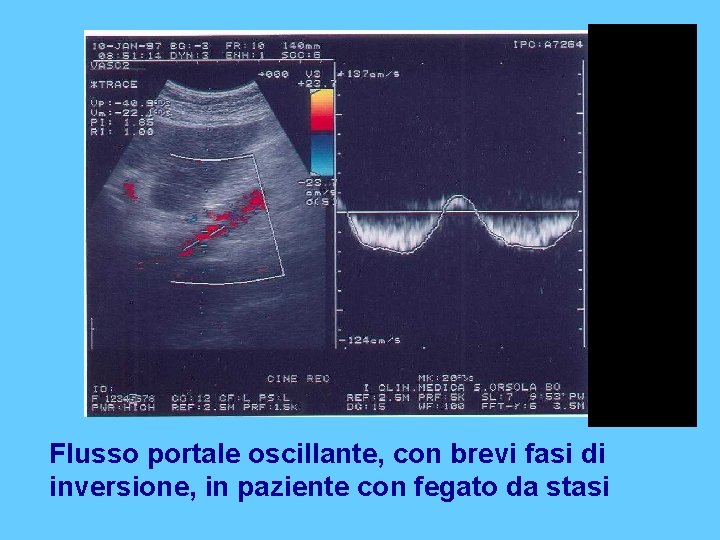 Flusso portale oscillante, con brevi fasi di inversione, in paziente con fegato da stasi