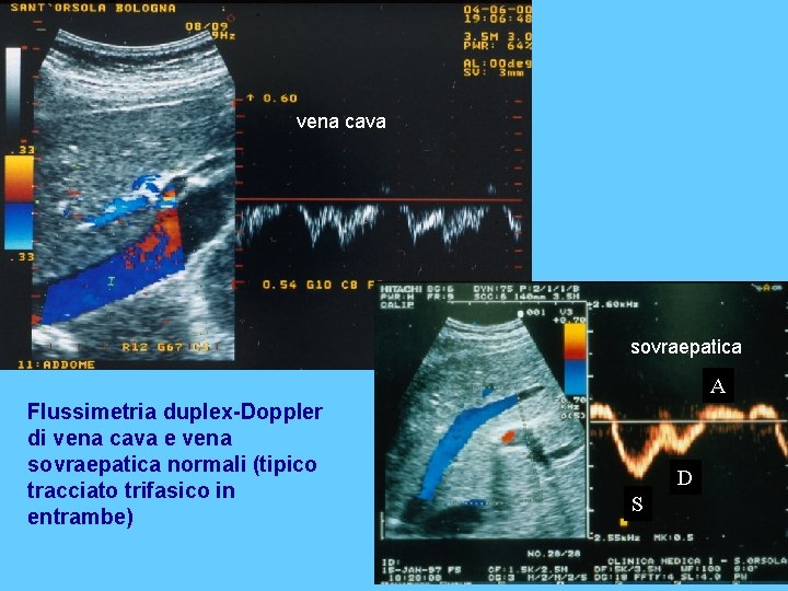 vena cava sovraepatica A Flussimetria duplex-Doppler di vena cava e vena sovraepatica normali (tipico