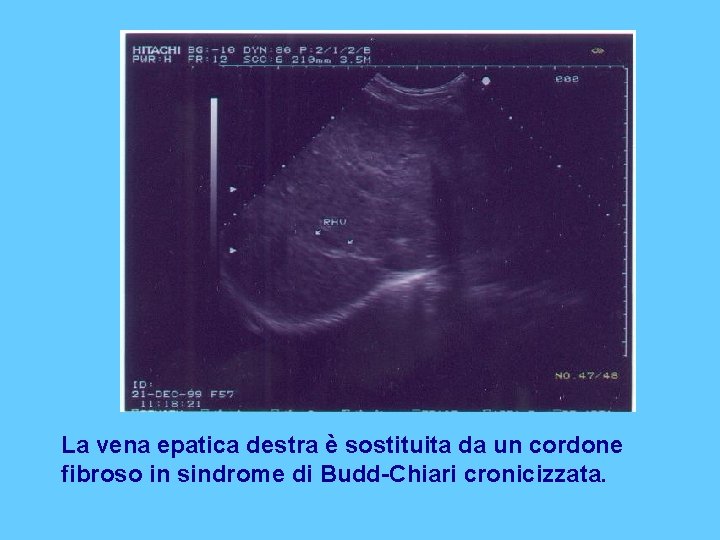 La vena epatica destra è sostituita da un cordone fibroso in sindrome di Budd-Chiari