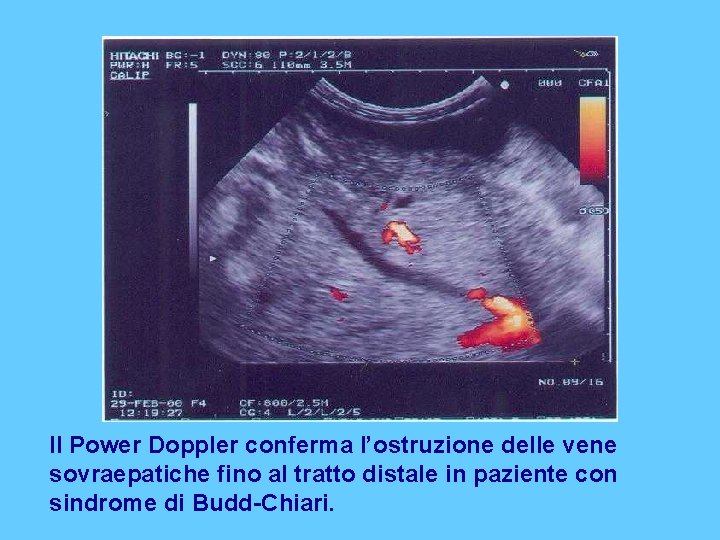 Il Power Doppler conferma l’ostruzione delle vene sovraepatiche fino al tratto distale in paziente