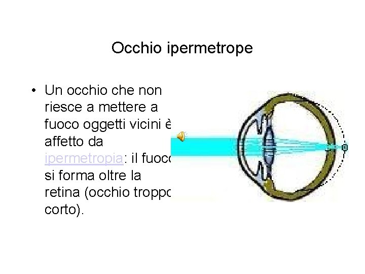 Occhio ipermetrope • Un occhio che non riesce a mettere a fuoco oggetti vicini