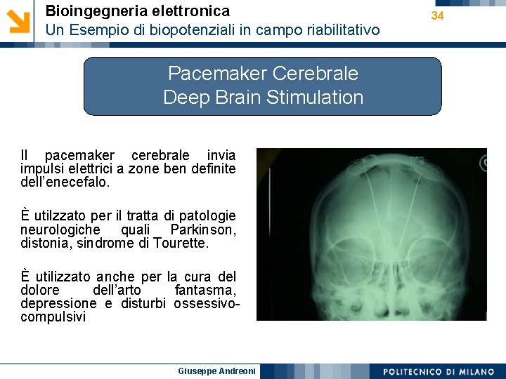 Bioingegneria elettronica Un Esempio di biopotenziali in campo riabilitativo Pacemaker Cerebrale Deep Brain Stimulation