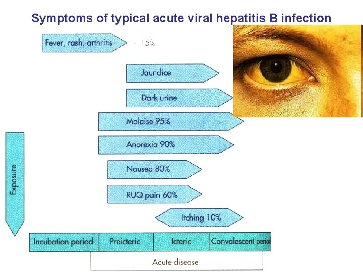 Symptoms of typical acute viral hepatitis B infection 