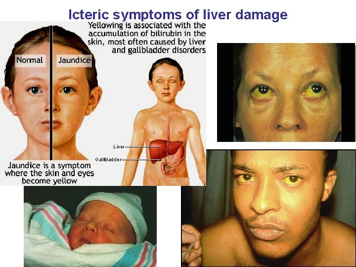 Icteric symptoms of liver damage 