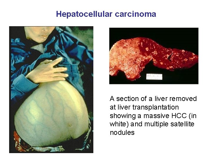 Hepatocellular carcinoma A section of a liver removed at liver transplantation showing a massive