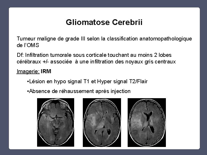 Gliomatose Cerebrii Tumeur maligne de grade III selon la classification anatomopathologique de l’OMS Df: