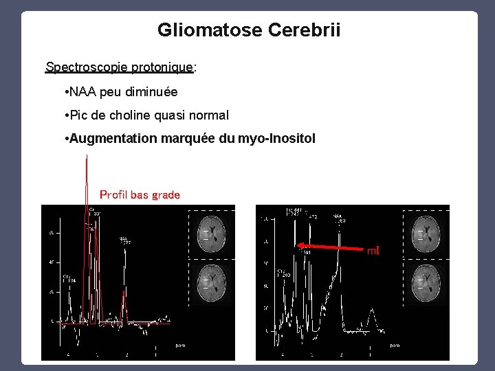 Gliomatose Cerebrii Spectroscopie protonique: • NAA peu diminuée • Pic de choline quasi normal