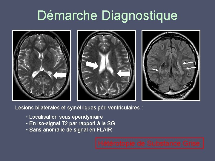 Démarche Diagnostique Lésions bilatérales et symétriques péri ventriculaires : • Localisation sous épendymaire •