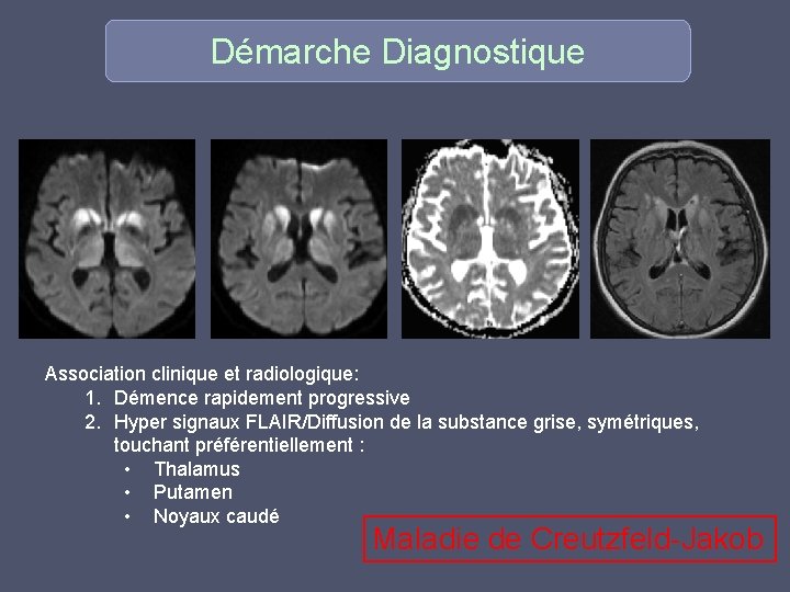 Démarche Diagnostique Association clinique et radiologique: 1. Démence rapidement progressive 2. Hyper signaux FLAIR/Diffusion