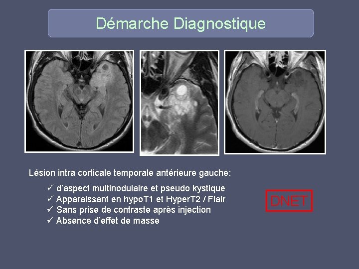 Démarche Diagnostique Lésion intra corticale temporale antérieure gauche: ü d’aspect multinodulaire et pseudo kystique