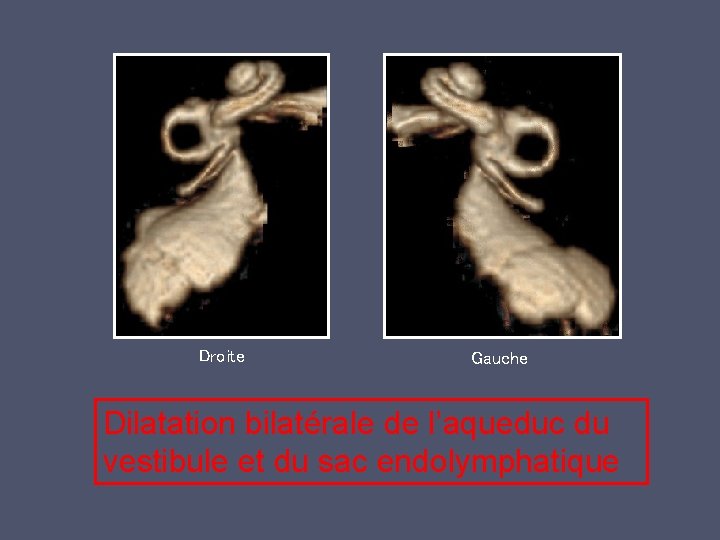 Droite Gauche Dilatation bilatérale de l’aqueduc du vestibule et du sac endolymphatique 