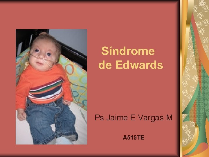 Síndrome de Edwards Ps Jaime E Vargas M A 515 TE 