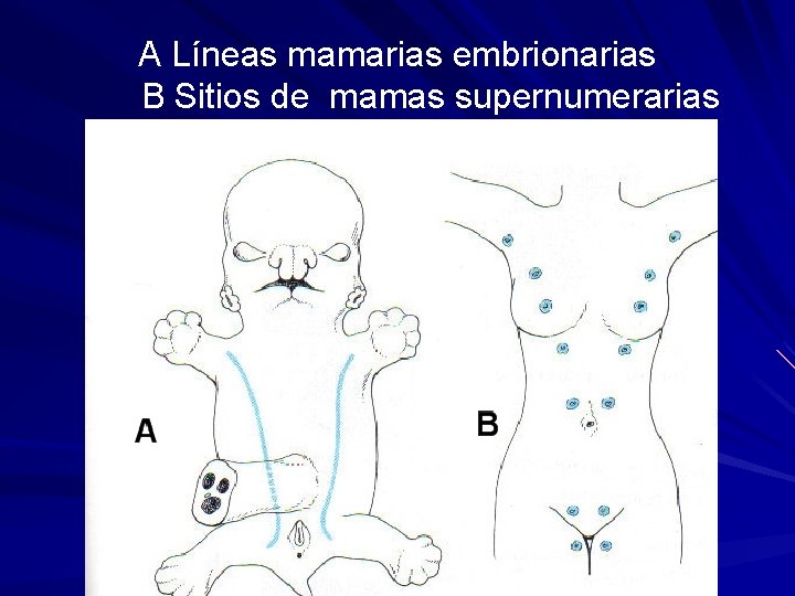 A Líneas mamarias embrionarias B Sitios de mamas supernumerarias 