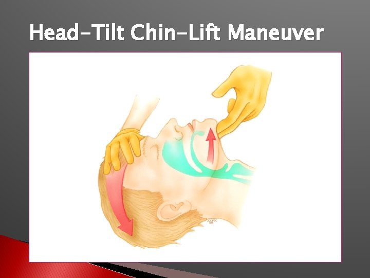 Head-Tilt Chin-Lift Maneuver 