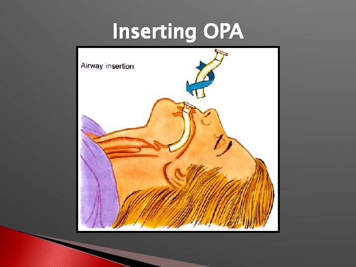 Inserting OPA 