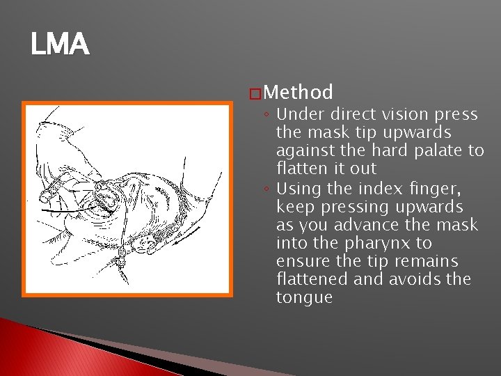 LMA � Method ◦ Under direct vision press the mask tip upwards against the