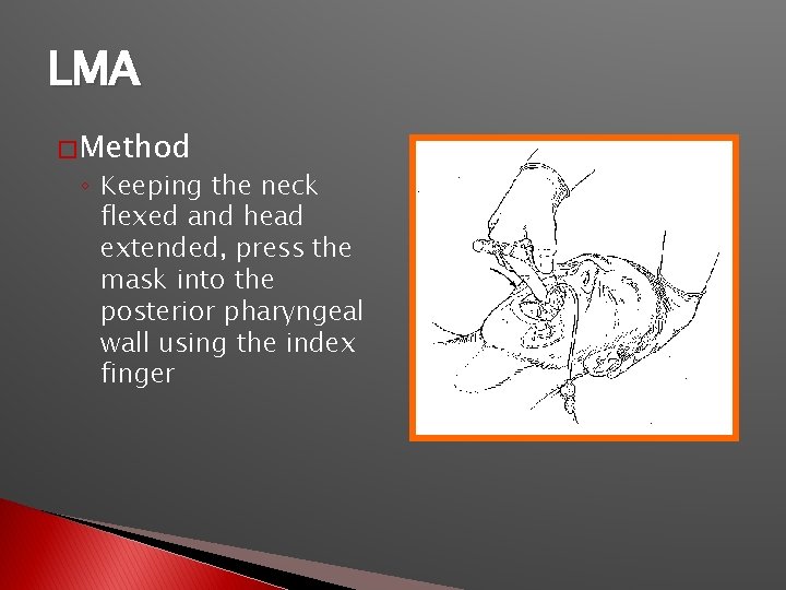 LMA � Method ◦ Keeping the neck flexed and head extended, press the mask