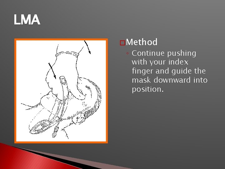 LMA � Method ◦ Continue pushing with your index finger and guide the mask