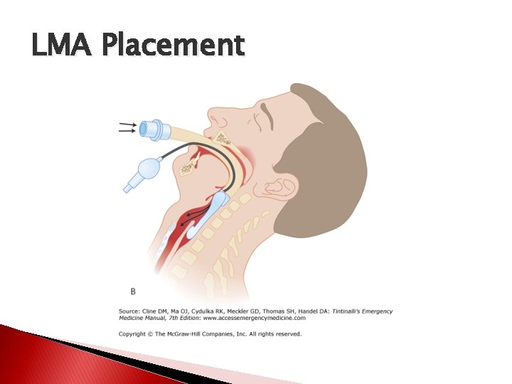 LMA Placement 