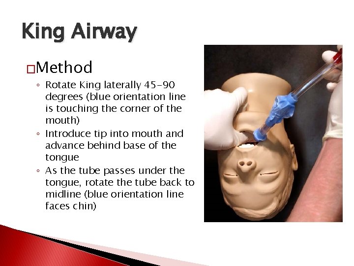 King Airway �Method ◦ Rotate King laterally 45 -90 degrees (blue orientation line is