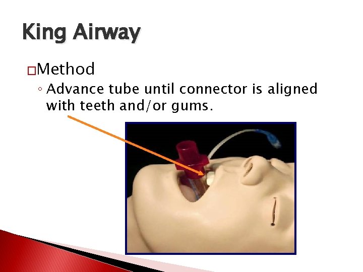 King Airway �Method ◦ Advance tube until connector is aligned with teeth and/or gums.