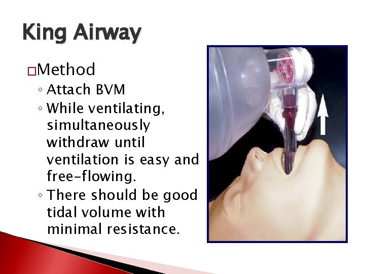 King Airway �Method ◦ Attach BVM ◦ While ventilating, simultaneously withdraw until ventilation is