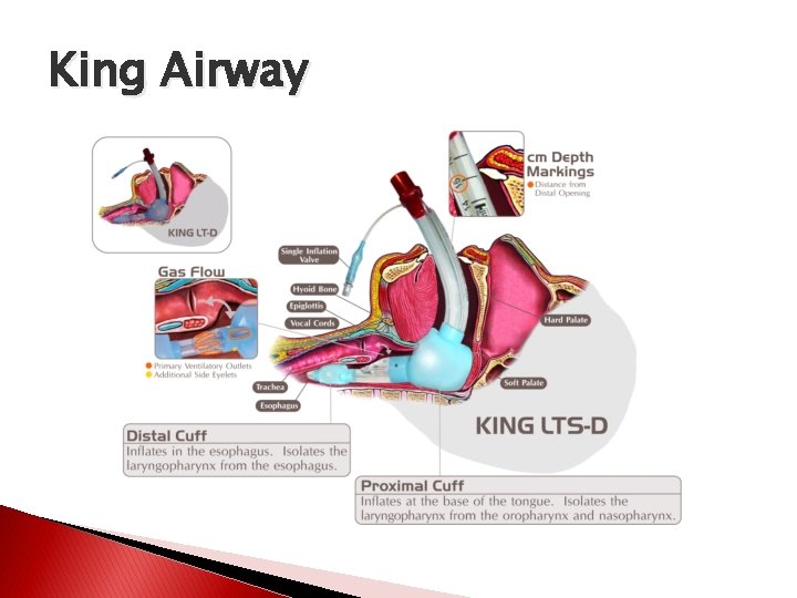 King Airway 