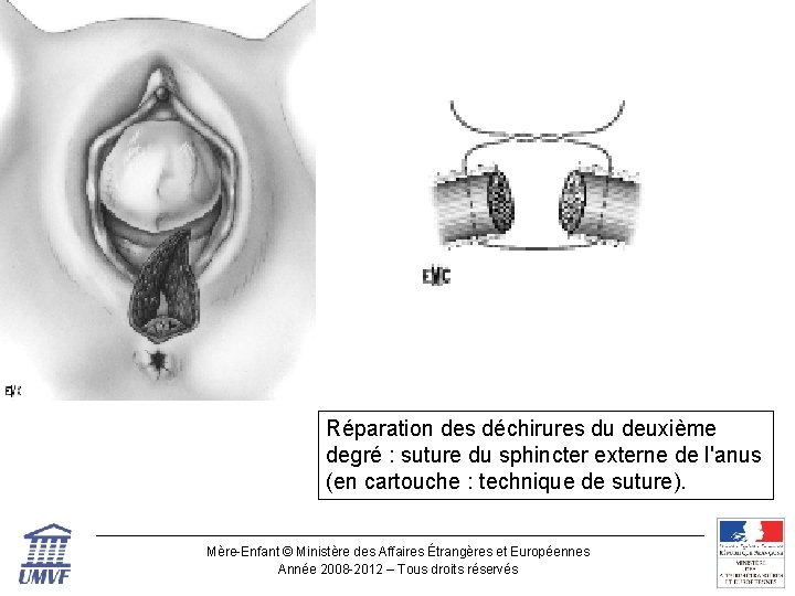 Réparation des déchirures du deuxième degré : suture du sphincter externe de l'anus (en