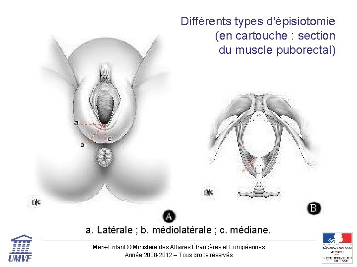 Différents types d'épisiotomie (en cartouche : section du muscle puborectal) a. Latérale ; b.