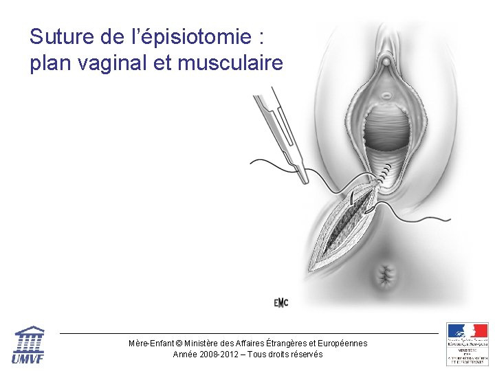 Suture de l’épisiotomie : plan vaginal et musculaire Mère-Enfant © Ministère des Affaires Étrangères