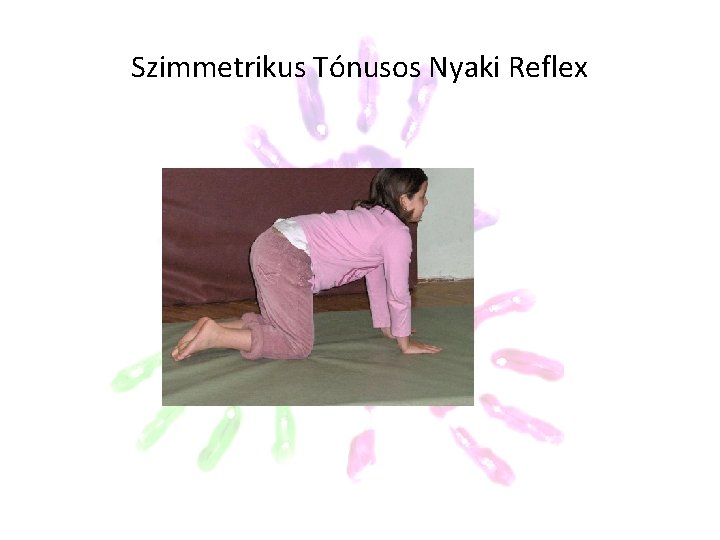 Szimmetrikus Tónusos Nyaki Reflex Szimmetrikus Tónusos Nyaki Reflex