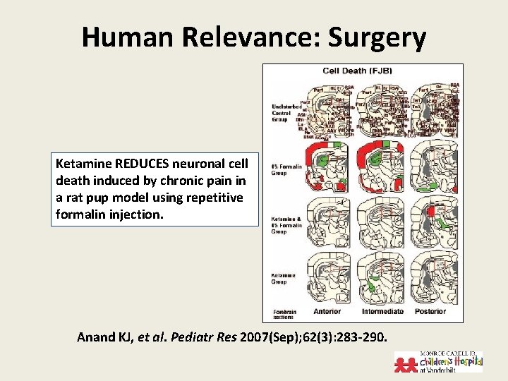 Human Relevance: Surgery Ketamine REDUCES neuronal cell death induced by chronic pain in a