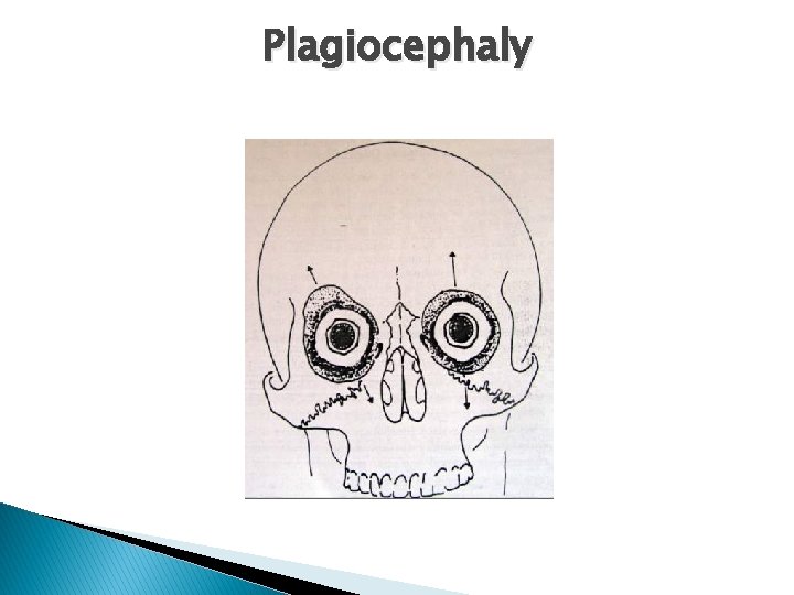 Plagiocephaly 