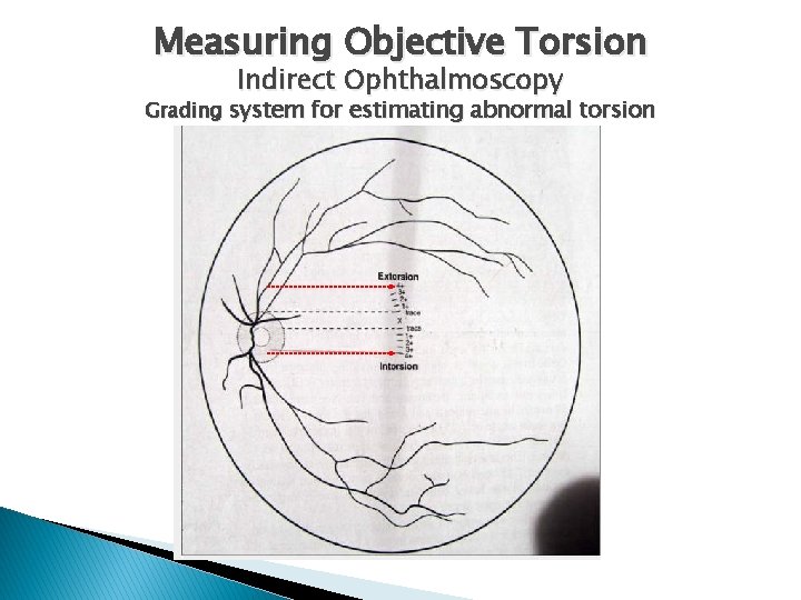 Measuring Objective Torsion Indirect Ophthalmoscopy Grading system for estimating abnormal torsion 