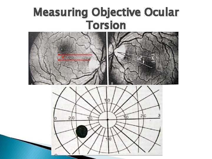 Measuring Objective Ocular Torsion X 