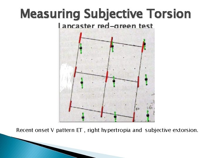 Measuring Subjective Torsion Lancaster red-green test Recent onset V pattern ET , right hypertropia