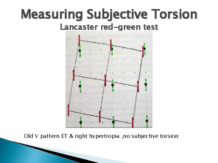 Measuring Subjective Torsion Lancaster red-green test Old V pattern ET & right hypertropia ,