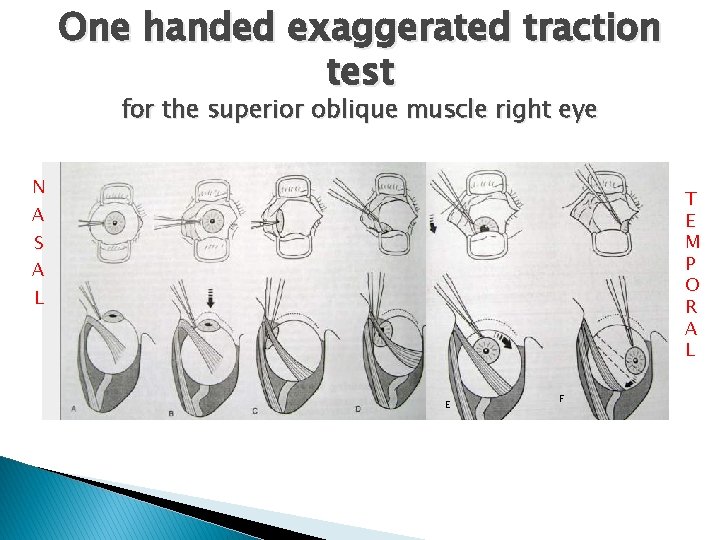 One handed exaggerated traction test for the superior oblique muscle right eye N T