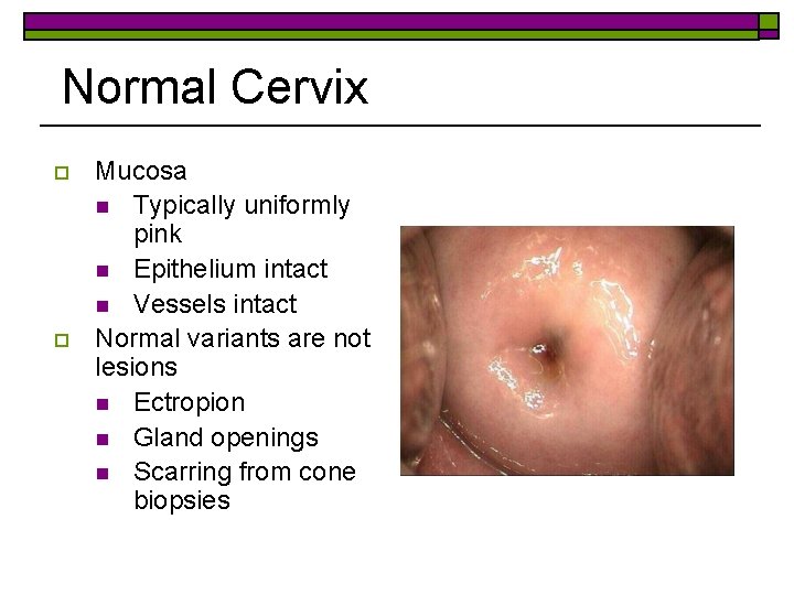 Normal Cervix o o Mucosa n Typically uniformly pink n Epithelium intact n Vessels